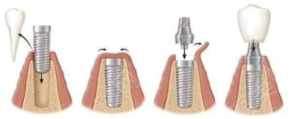 种植牙17.jpg
