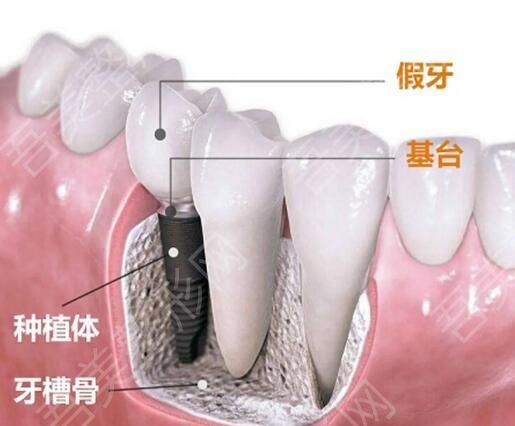 牙 种植5.jpg