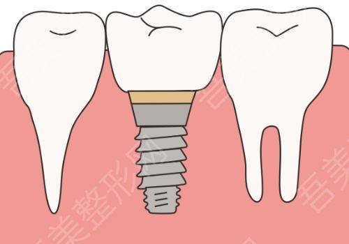 种植牙6.jpg