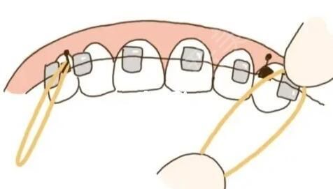 牙齿矫正动漫36.jpg
