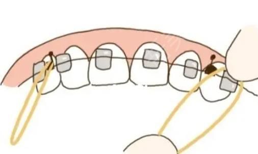 牙齿矫正卡通图05.jpg