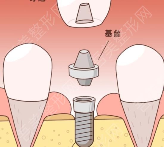 牙齿种植dm04.jpg