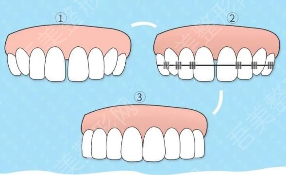 矫正牙齿7.jpg