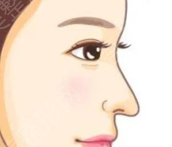 隆鼻手术动漫图05.jpg