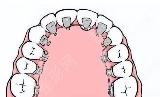 牙齿矫正动漫02.jpg