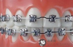 什么是自锁托槽牙齿矫正？3M自锁托槽有什么功能？