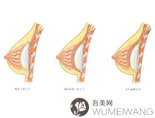 胸部整形术要花多少钱