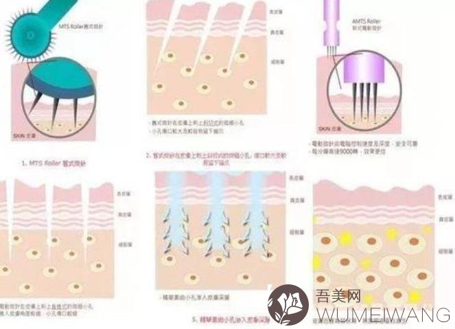 北京光子嫩肤价格多少钱