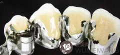钯金烤瓷牙有什么优点？详细讲解烤瓷牙的优缺点及术后护理