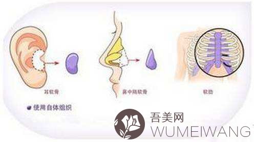 自体软骨隆鼻没问题吗