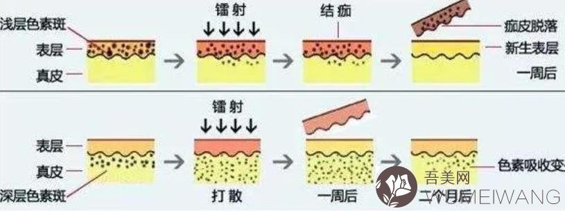 上海激光祛斑案例