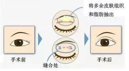 西京医院刘恒鑫科普双眼皮手术