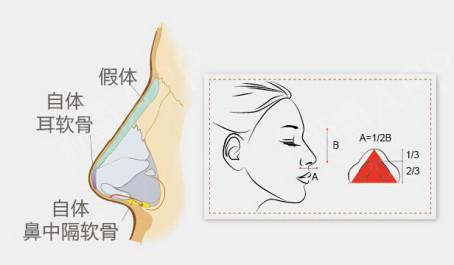 香港V Beauty医学中心陈医生科普隆鼻手术