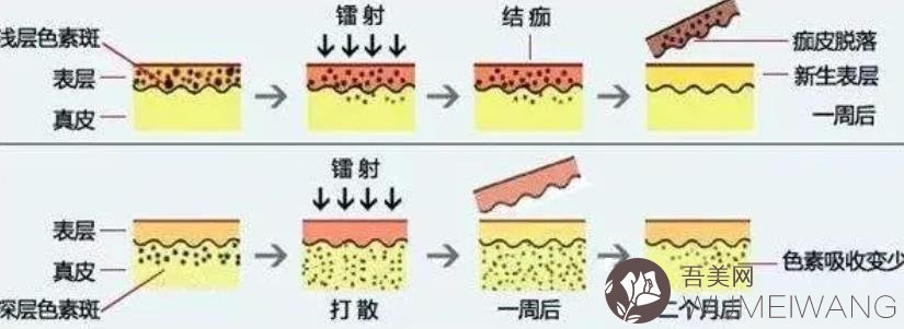 c8祛斑术后注意事项