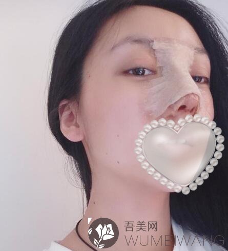 成都锦江致心医疗美容门诊部歪鼻矫正案例