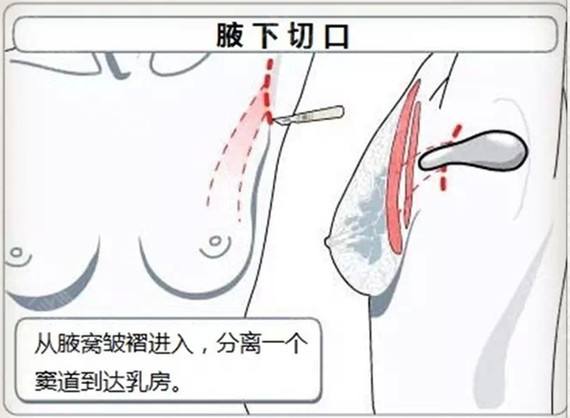 华西医院肖海涛医生科普隆胸