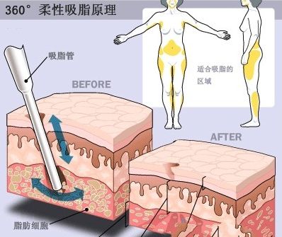 沈阳徐医生整形徐广科普大腿吸脂手术