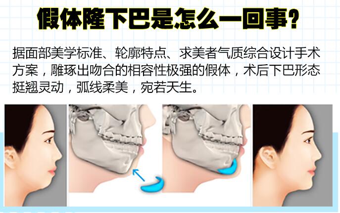 上海九院魏皎医生科普垫下巴手术