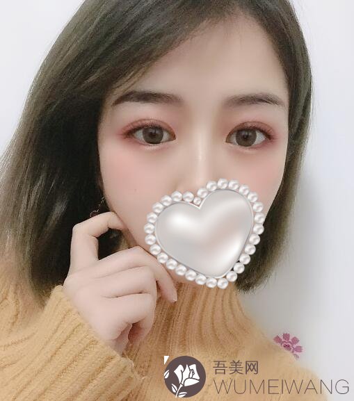 成都温江真美奇迹医疗美容诊所双眼皮案例