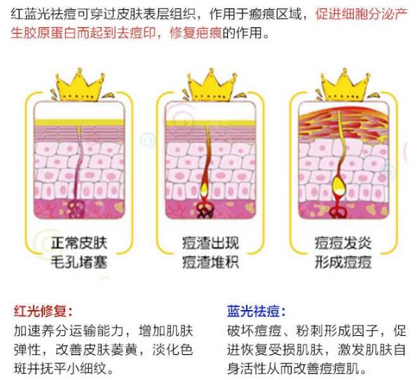 长痘的正确解决办法