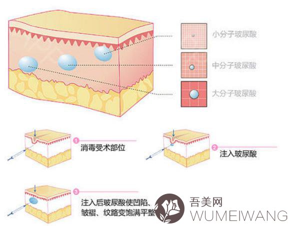 大分子玻尿酸的费用