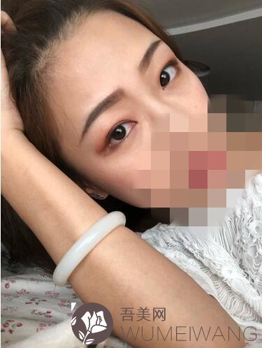 成都花田宜美医疗美容诊所去眼袋案例