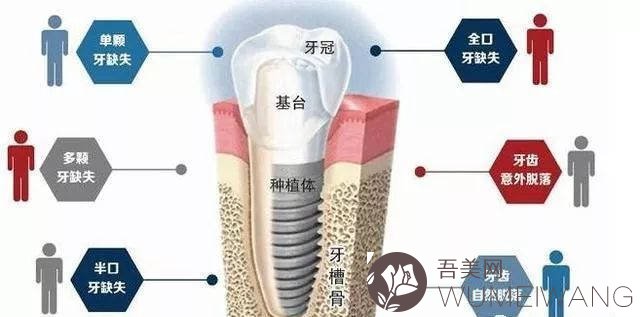 上海易美口腔门诊部口腔科科普种植牙