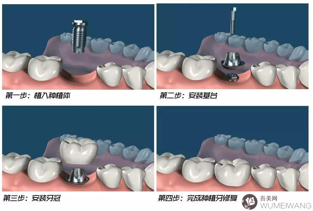 上海易美口腔门诊部口腔科科普种植牙