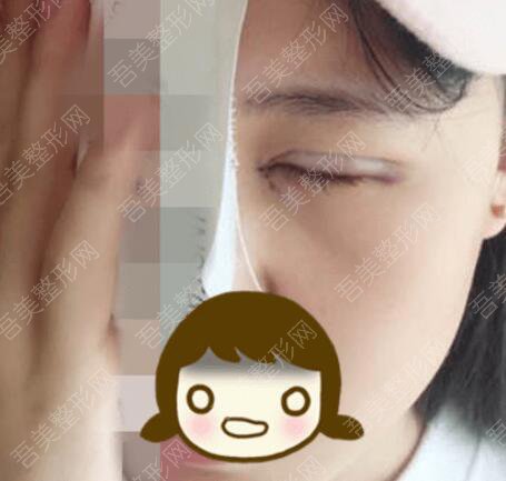 重庆周业松医疗美容诊所双眼皮整形案例