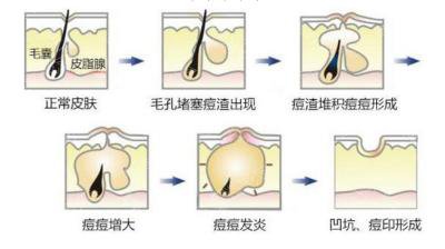 西京医院激光美容中心祛痘科普