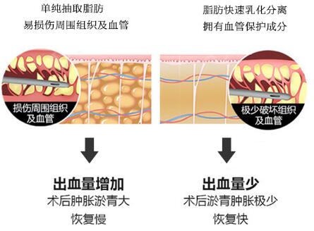 三、上海朱莉医生科普抽脂整形