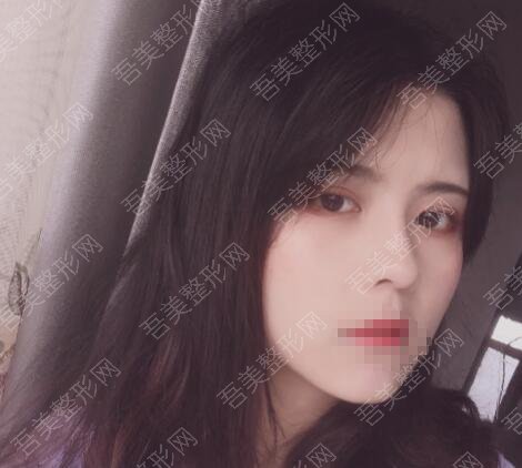 成都美妍汇医疗美容诊所鼻整形案例