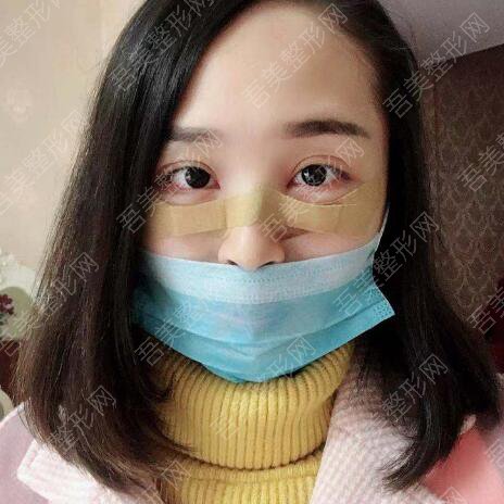 成都美妍汇医疗美容诊所去眼袋案例