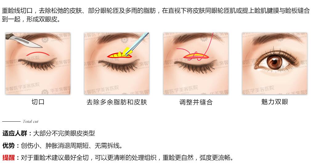 成都驻颜整形美容刘培医生科普双眼皮手术知识