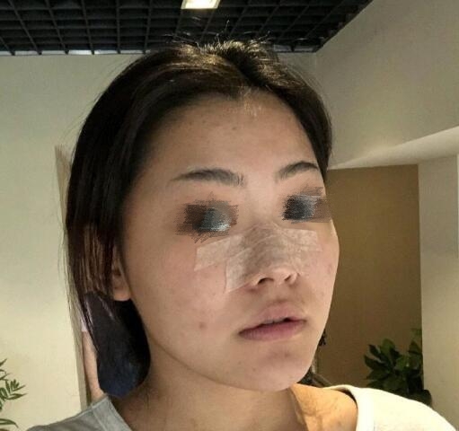 深圳美莱整形美容医院隆鼻案例