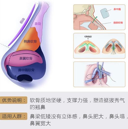 广州美恩整形医院科普隆鼻手术