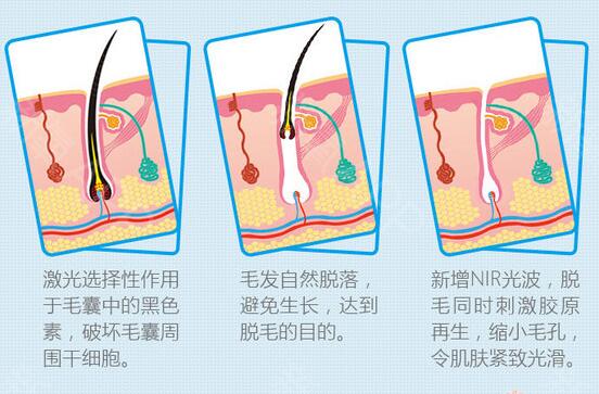 济源林华整形医院科普脱毛手术知识