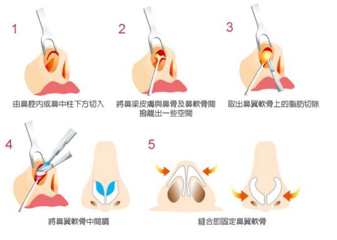 深圳世纪河山口腔门诊部科普手术缩鼻头