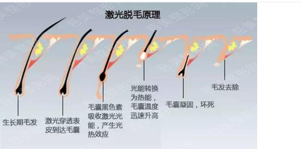 北京丽都整形医院擅长项目科普——光子脱毛