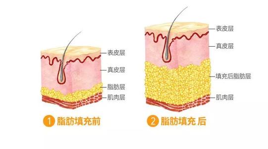 成都恒博李烈医生科普脂肪填充