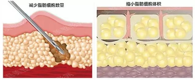 　乌鲁木齐子桐整形李咏红医生科普吸脂