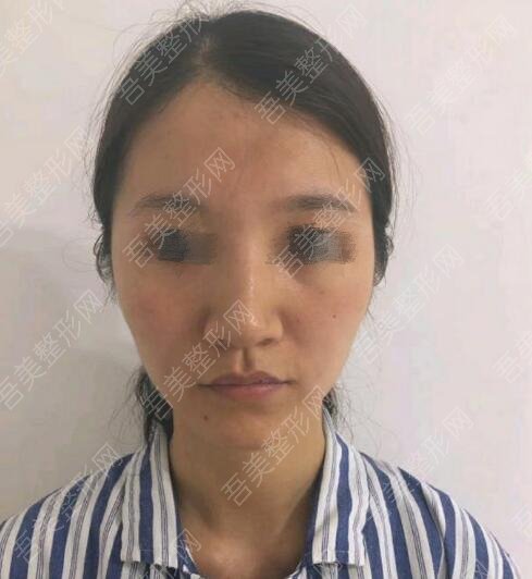 天津知妍医疗美容门诊部自体脂肪填充案例