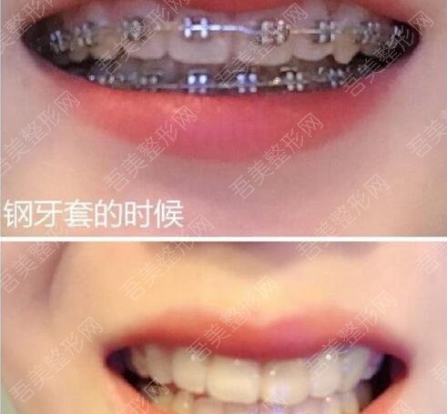 重庆武隆健美口腔医院牙齿矫正案例