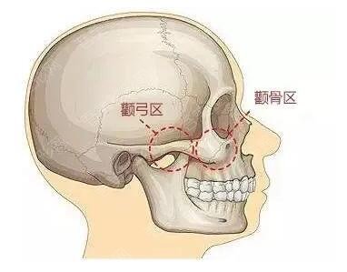 重庆华美颧骨整形手术