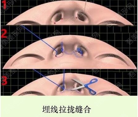 异常中爱整形医院鼻翼整形手术案例图