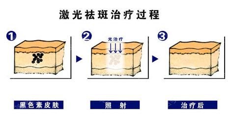 佛山中医院皮肤科激光祛斑果图