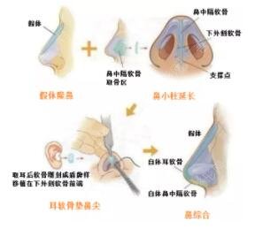 隆鼻过程