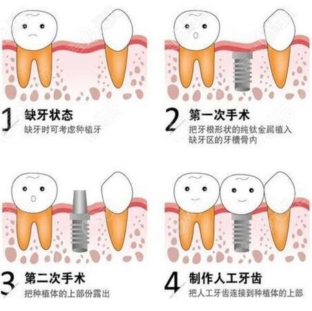 中山大学附属第五医院口腔科种植牙体验