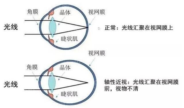 武汉医院飞秒调节近视眼案例精选