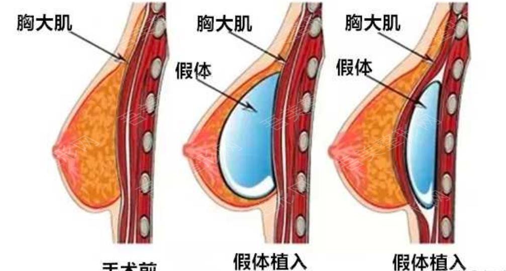 隆胸